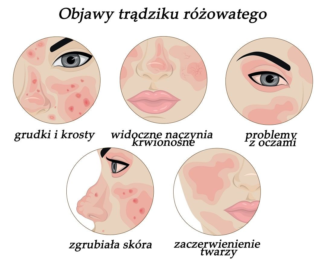 Objawy Trądziku Różowatego